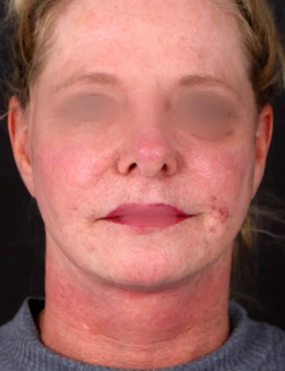 After face lifting in Dubai, patient 1