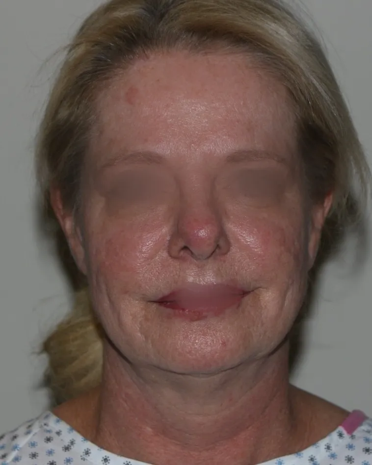 Before face lifting in Dubai, patient 1