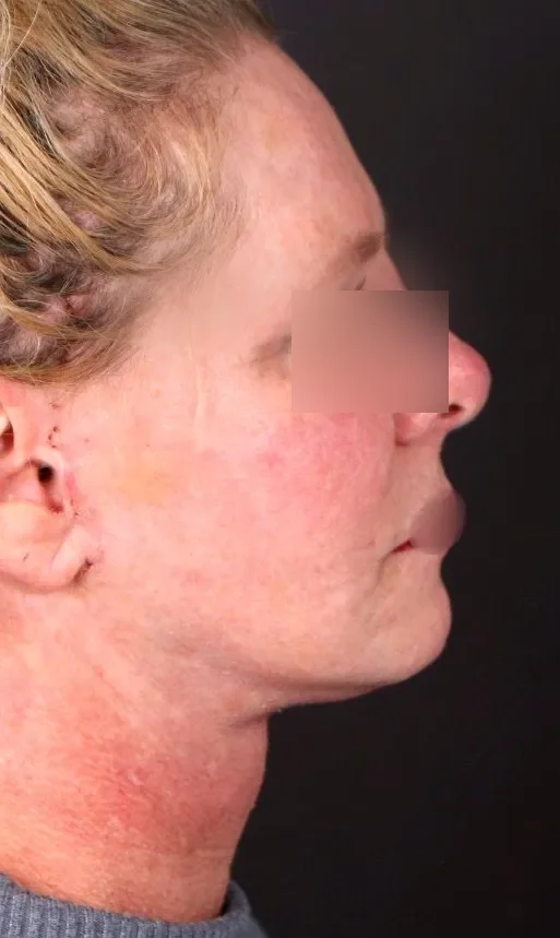 After face lifting in Dubai, patient 2