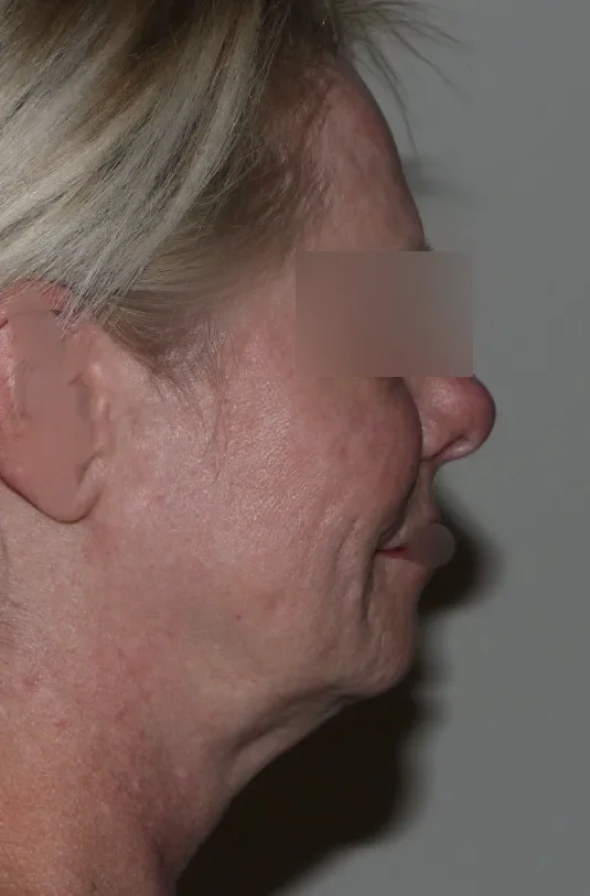 Before face lifting in Dubai, patient 2