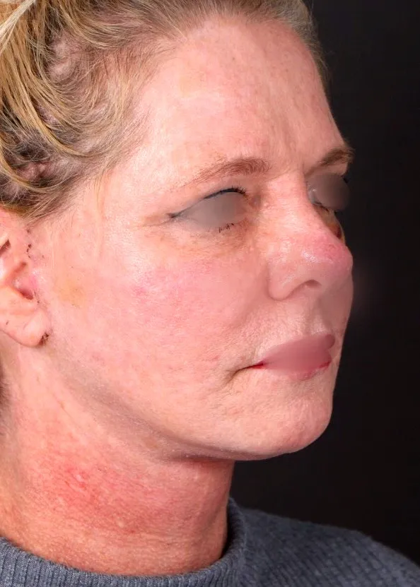 After face lifting in Dubai, patient 3