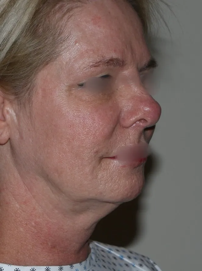 Before face lifting in Dubai, patient 3