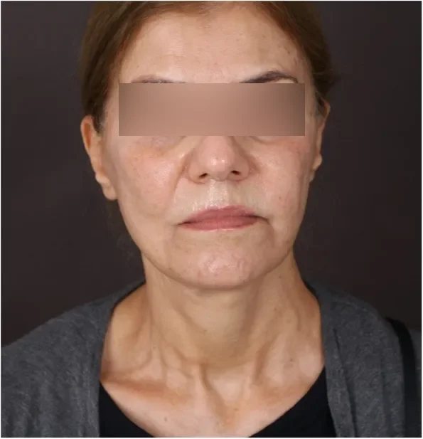 After face lifting in Dubai, patient 4
