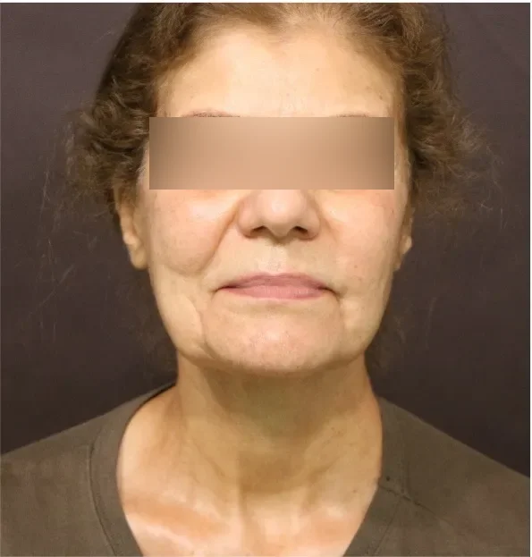 Before face lifting in Dubai, patient 4