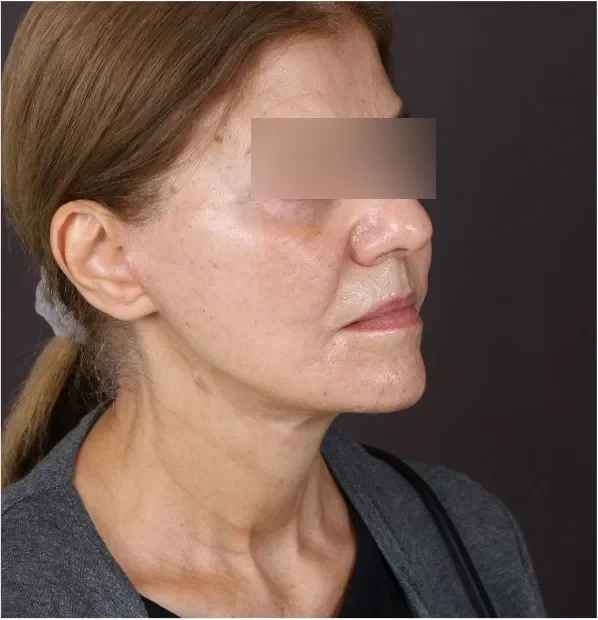 After face lifting in Dubai, patient 5
