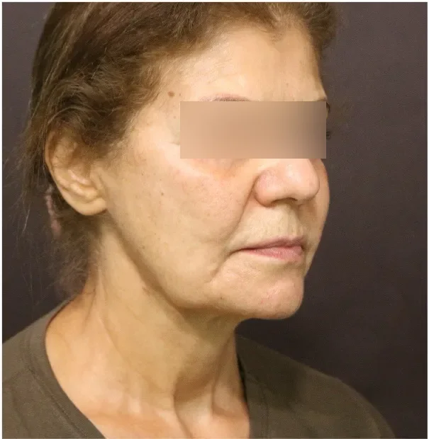 Before face lifting in Dubai, patient 5