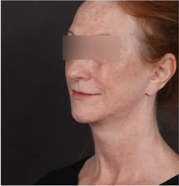 After face lifting in Dubai, patient 6