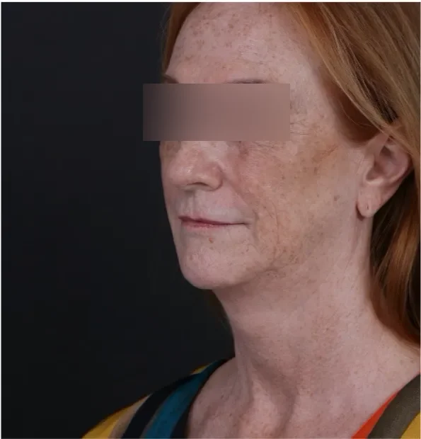Before face lifting in Dubai, patient 6