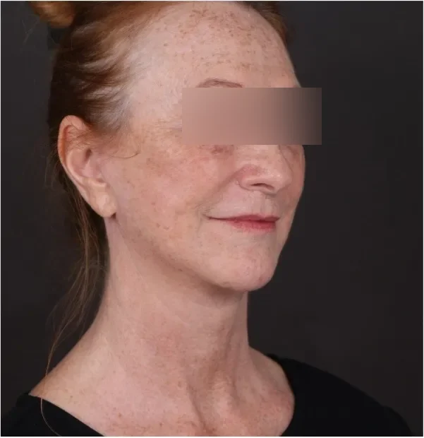After face lifting in Dubai, patient 7