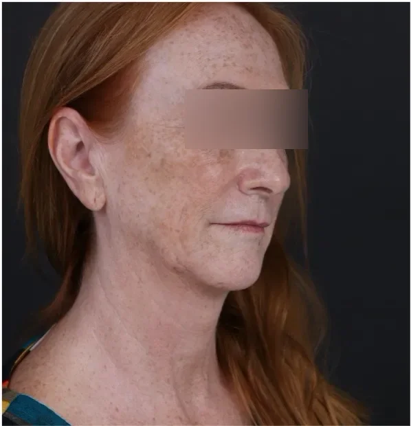 Before face lifting in Dubai, patient 7