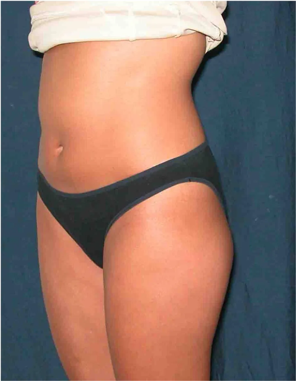 Before waist liposuction in Dubai, patient 1