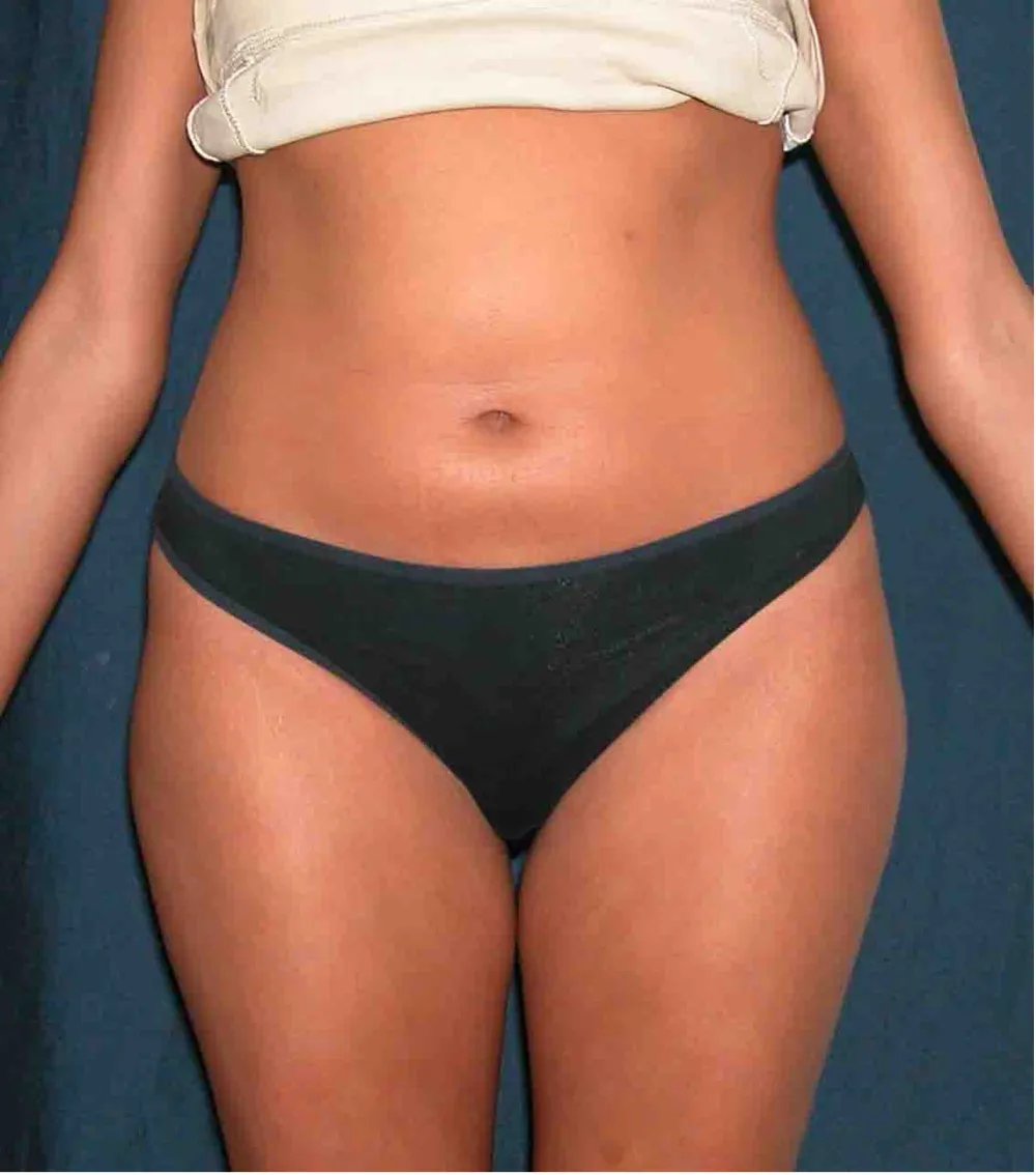 Before waist liposuction in Dubai, patient 2