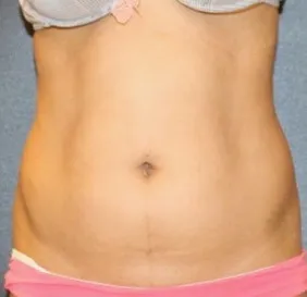 Before waist liposuction in Dubai, patient 3