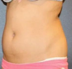 Before waist liposuction in Dubai, patient 4