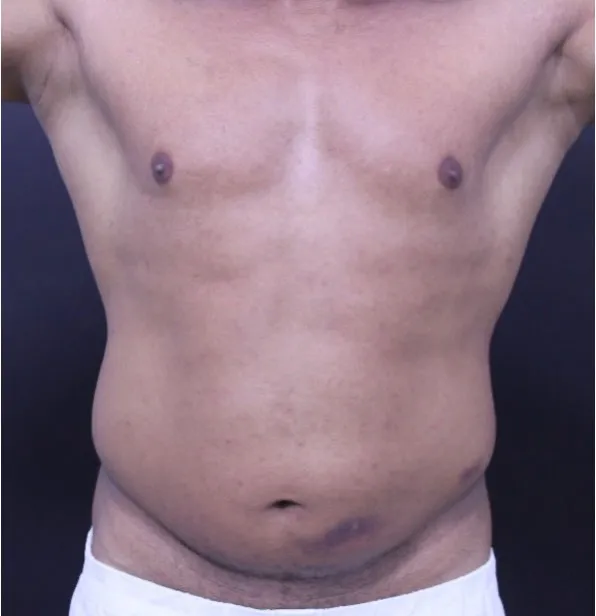 Before sixpack liposuction in Dubai, patient 1