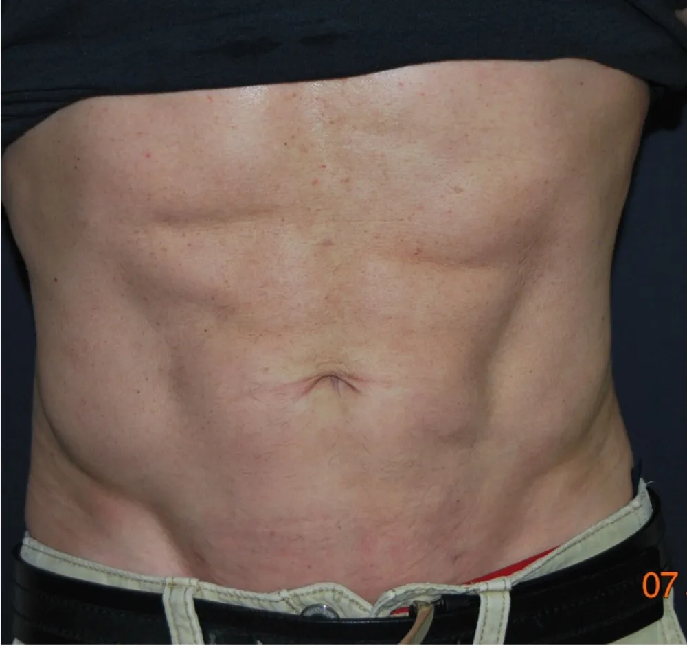 After sixpack liposuction in Dubai, patient 2