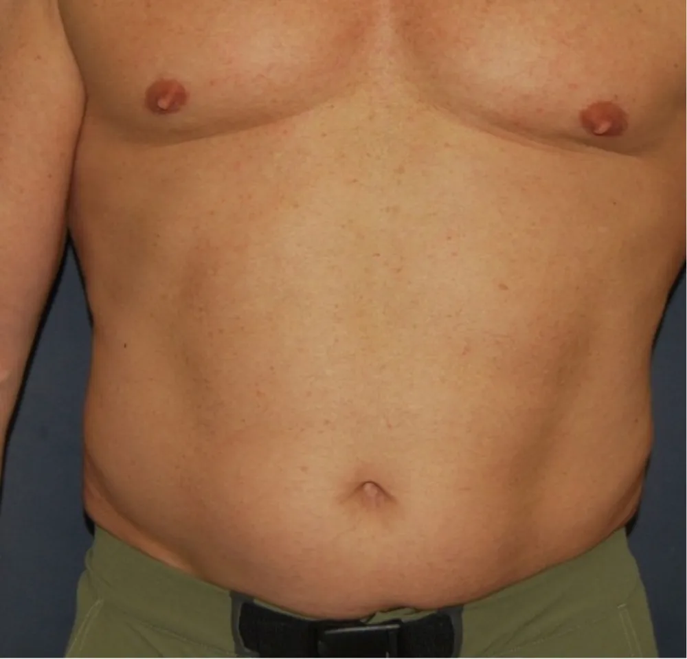 Before sixpack liposuction in Dubai, patient 2