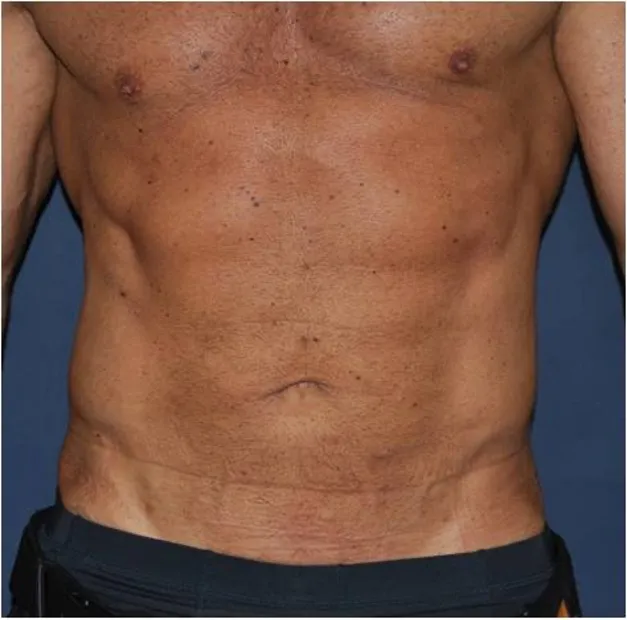 After sixpack liposuction in Dubai, patient 3