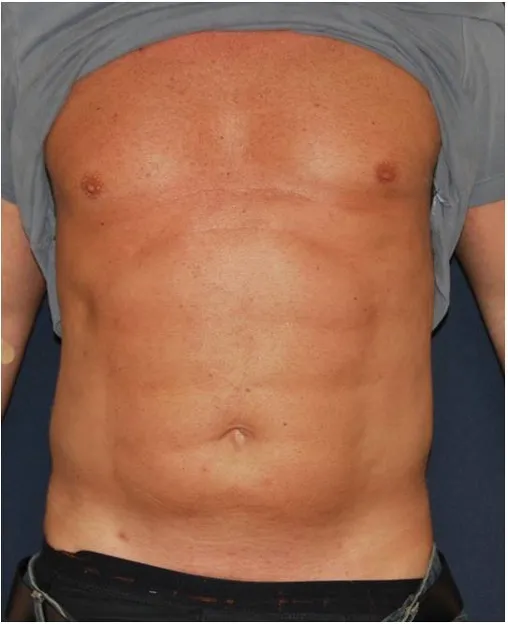 Before sixpack liposuction in Dubai, patient 3
