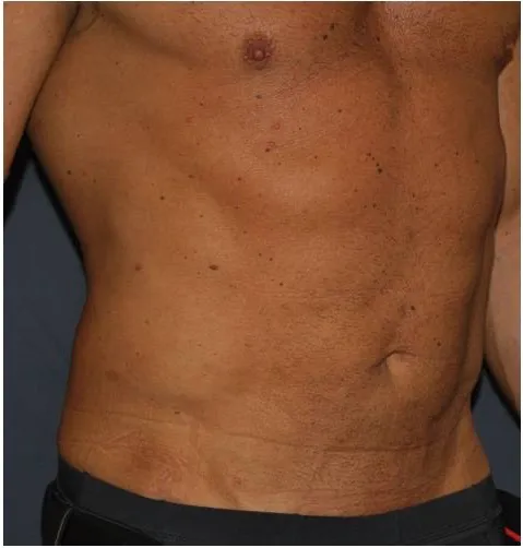 After sixpack liposuction in Dubai, patient 4