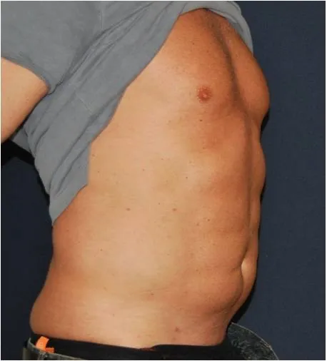 Before sixpack liposuction in Dubai, patient 4