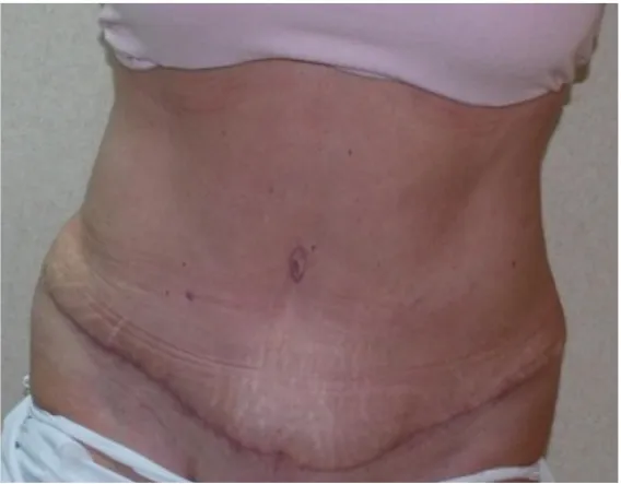 After tummy tuck in Dubai, patient 1