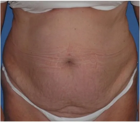 Before tummy tuck in Dubai, patient 1