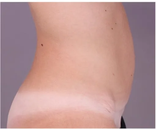 After tummy tuck in Dubai, patient 10
