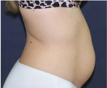 Before tummy tuck in Dubai, patient 10