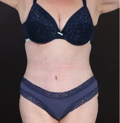 After tummy tuck in Dubai, patient 11