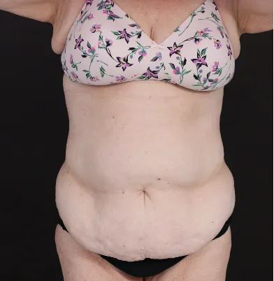 Before tummy tuck in Dubai, patient 11
