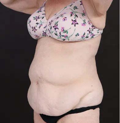 Before tummy tuck in Dubai, patient 12