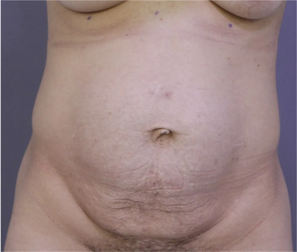 Before tummy tuck in Dubai, patient 13