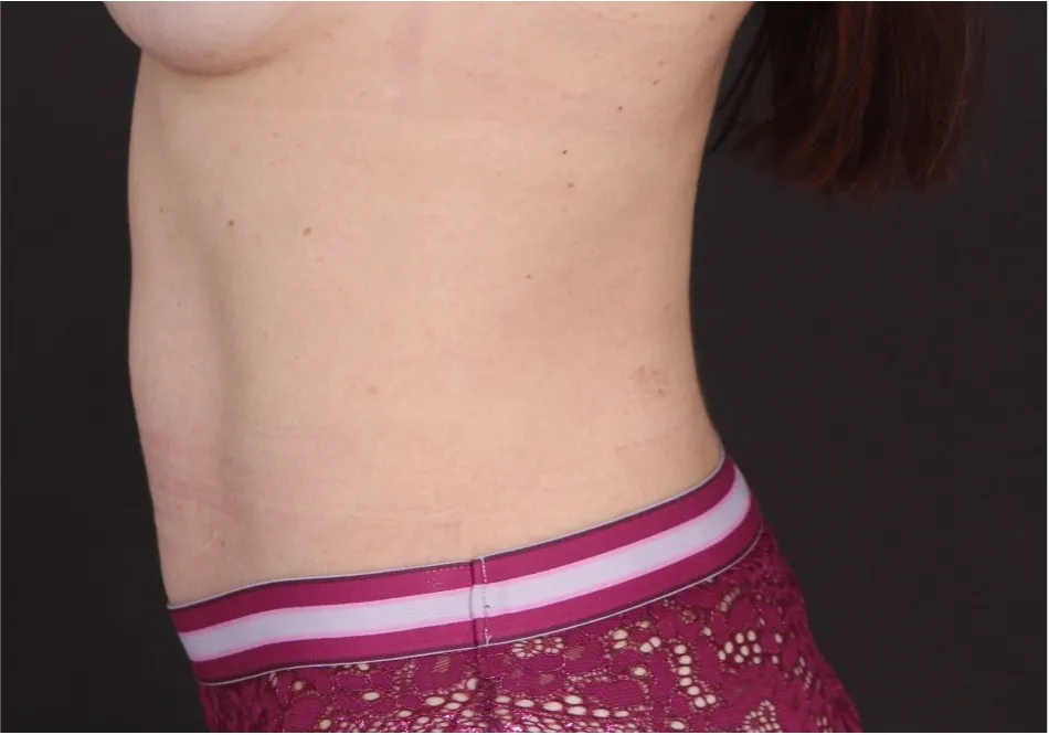 After tummy tuck in Dubai, patient 14