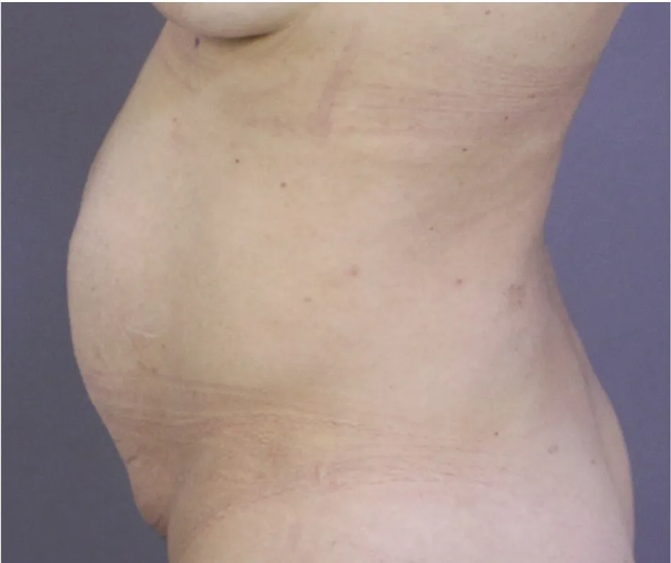 Before tummy tuck in Dubai, patient 14
