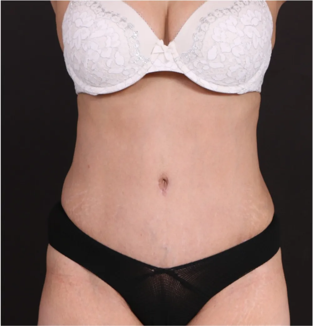 After tummy tuck in Dubai, patient 15