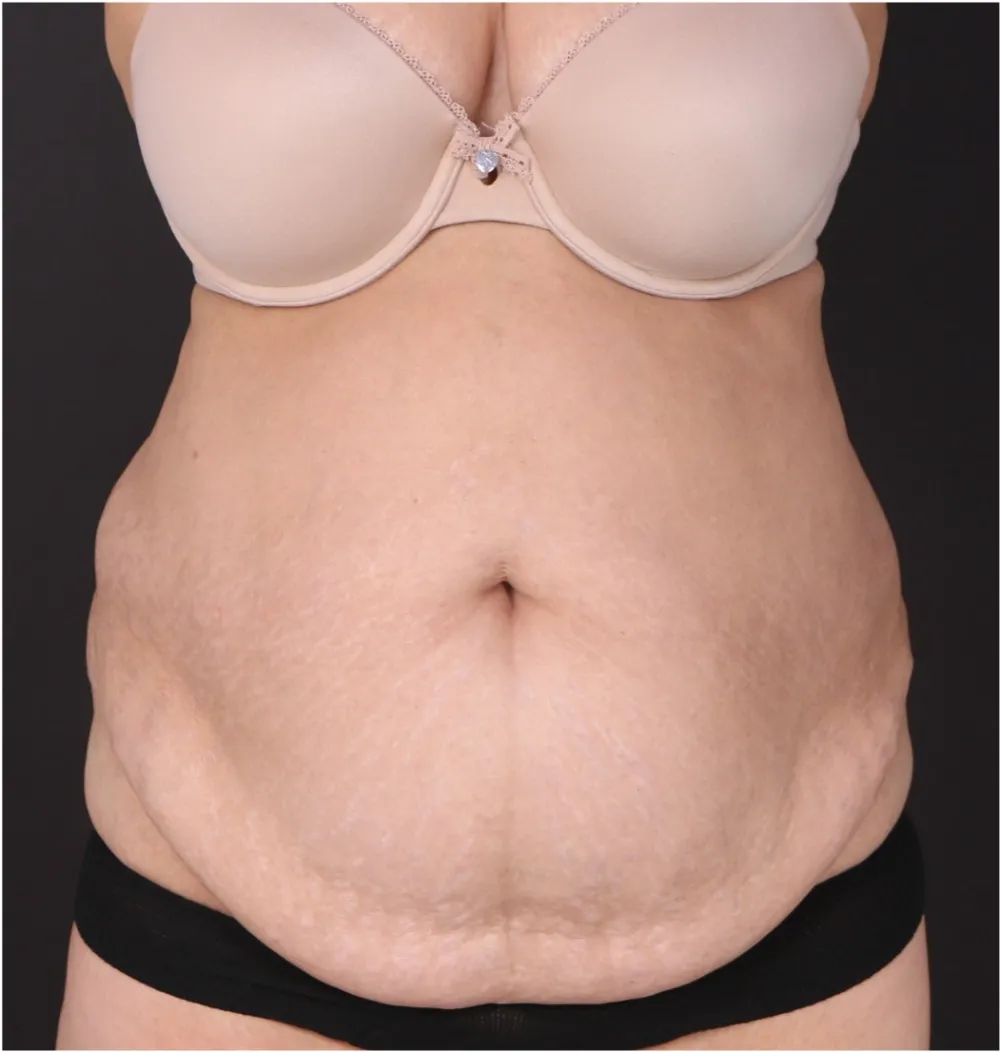 Before tummy tuck in Dubai, patient 15