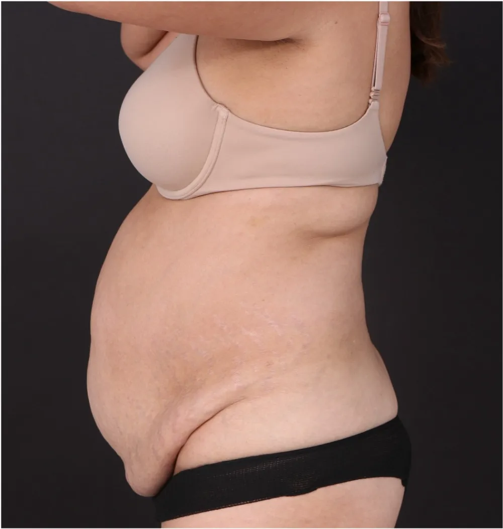Before tummy tuck in Dubai, patient 16
