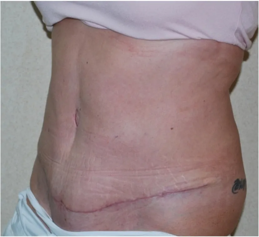 After tummy tuck in Dubai, patient 2