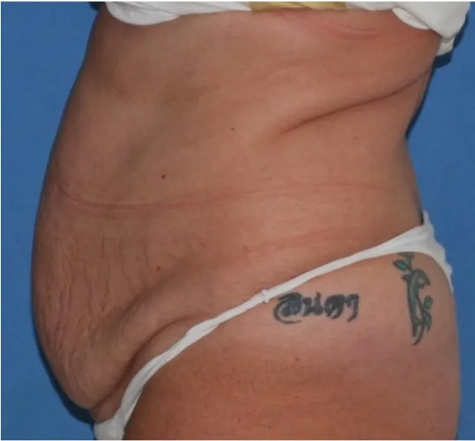 Before tummy tuck in Dubai, patient 2