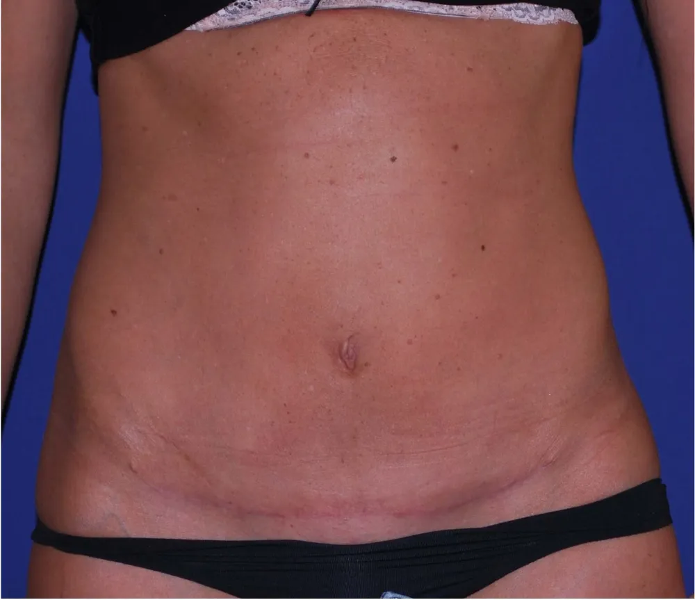 After tummy tuck in Dubai, patient 3