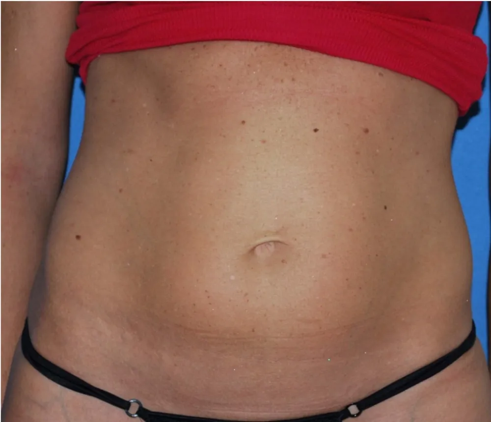 Before tummy tuck in Dubai, patient 3