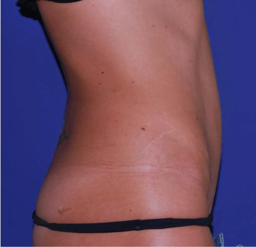 After tummy tuck in Dubai, patient 4