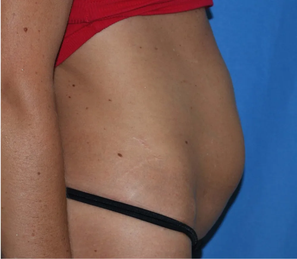 Before tummy tuck in Dubai, patient 4