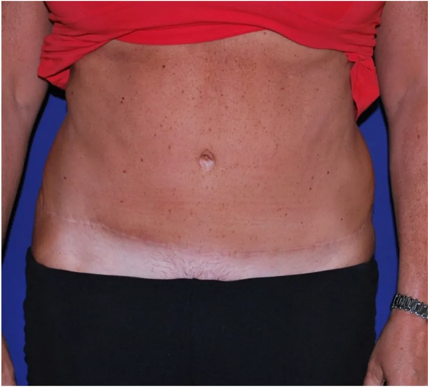 After tummy tuck in Dubai, patient 5