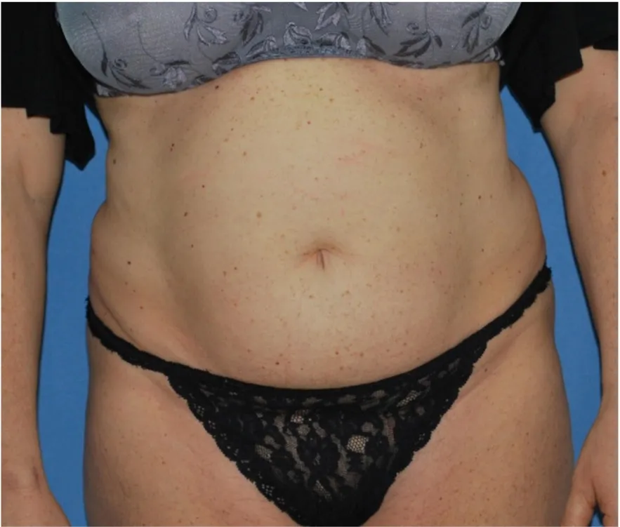 Before tummy tuck in Dubai, patient 5