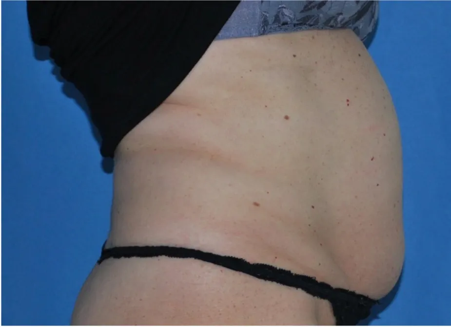 Before tummy tuck in Dubai, patient 6