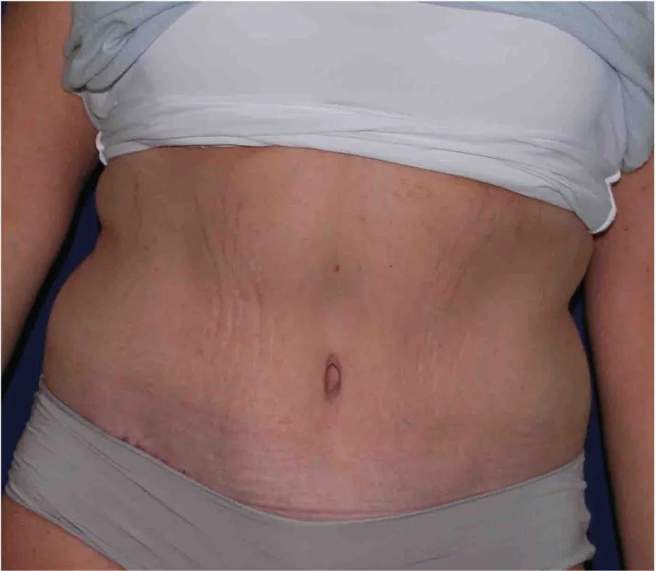 After tummy tuck in Dubai, patient 7