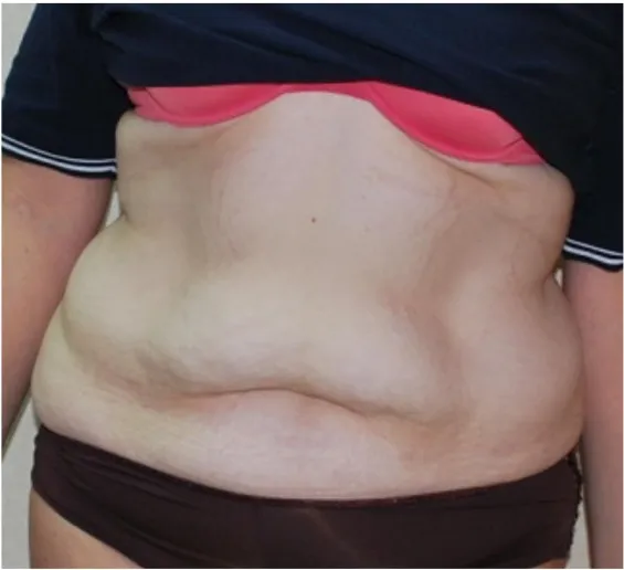 Before tummy tuck in Dubai, patient 7
