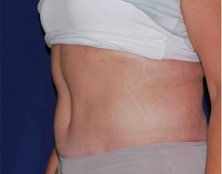 After tummy tuck in Dubai, patient 8